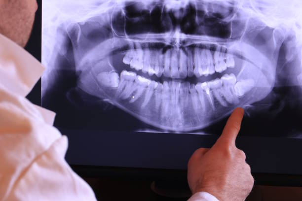 Best Emergency Wisdom Teeth Removal in Maurice, LA